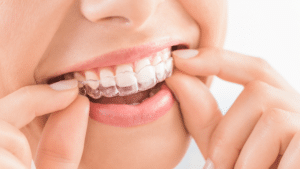 How-to-Straighten-Your-Teeth-Without-Braces? How to Straighten Teeth Without Braces?